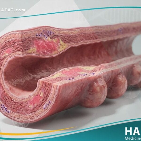 إلتهاب الشرايين العقدي الكلي