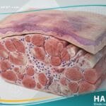 _إلتهاب العضلات والجلد (1)
