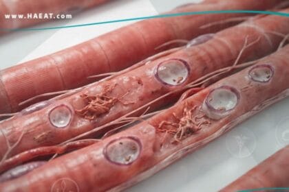 اعتلال عضلي مشتمل