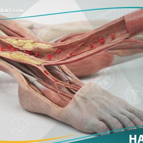 اقفار الطرف الحرج