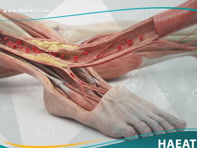 اقفار الطرف الحرج