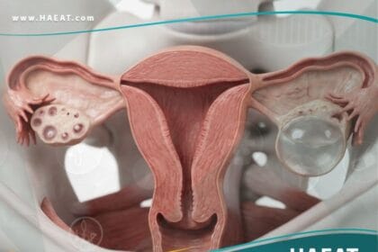 اكياس على المبايض