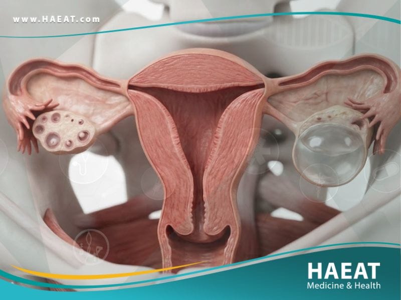 اكياس على المبايض