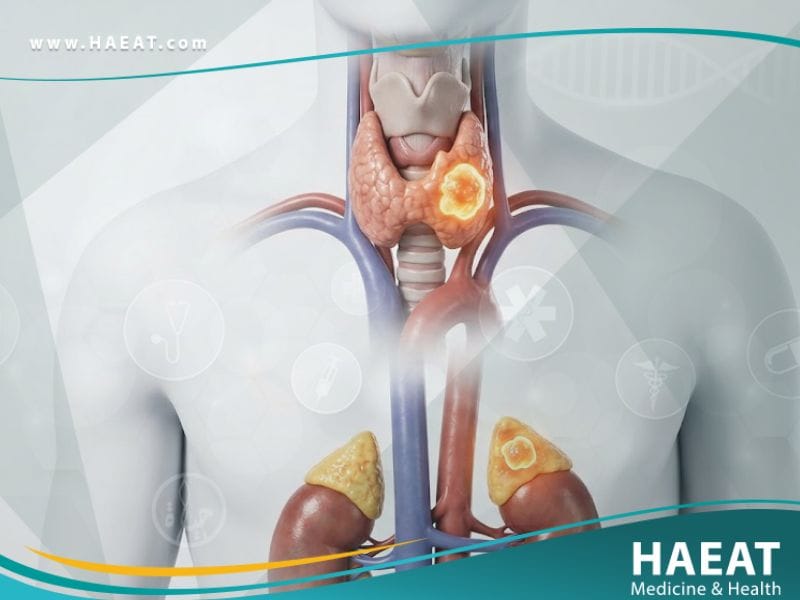 الأورام الصماوية