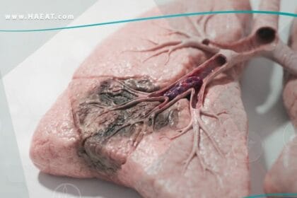 الاحتشاء الرئوي