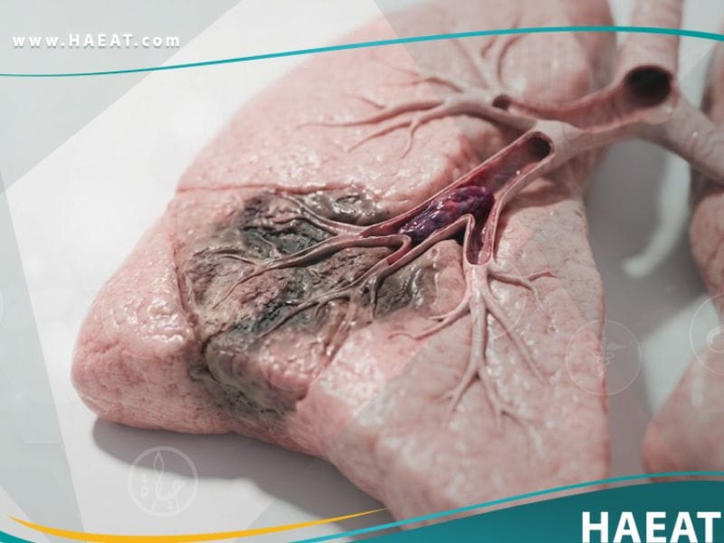 الاحتشاء الرئوي