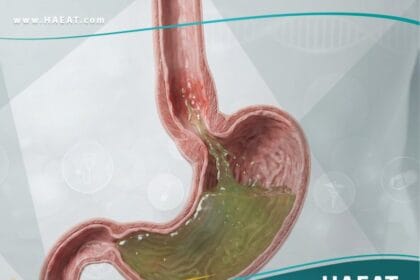 الارتجاع المعدي المريئي