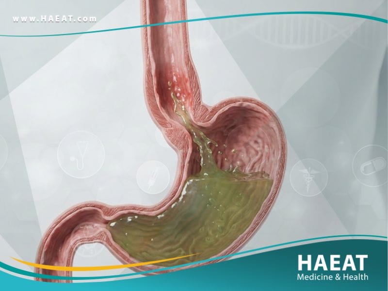 الارتجاع المعدي المريئي