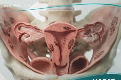 الانتباذ البطاني الرحمي