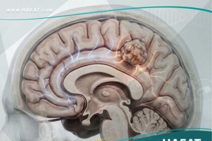 _الاورام الدماغية