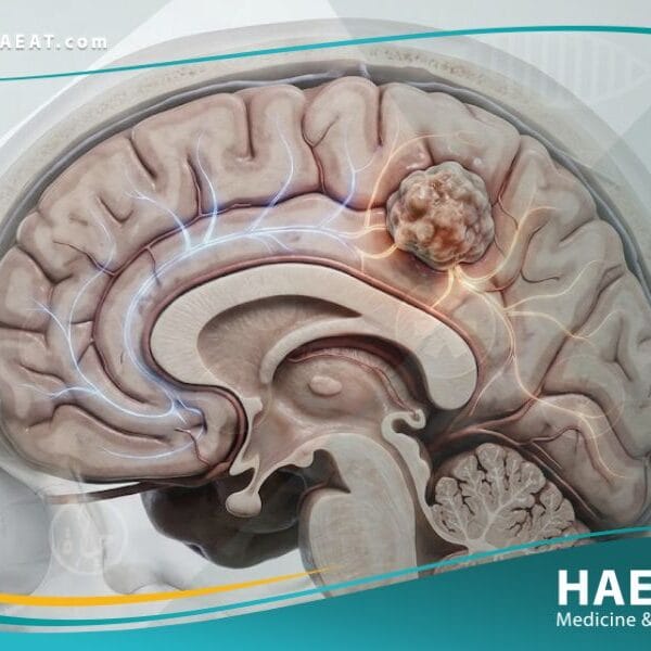_الاورام الدماغية