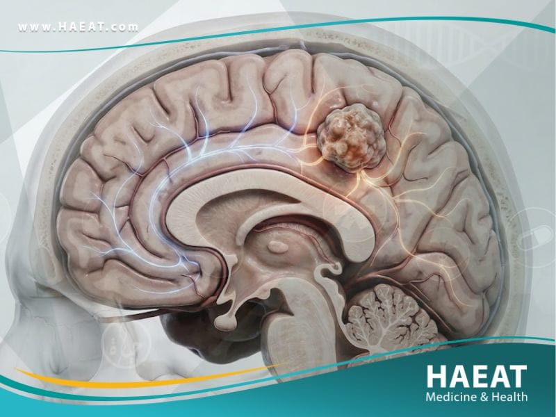 _الاورام الدماغية