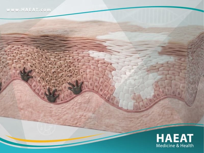 البهاق | 7 حقائق عن الأعراض، الأسباب، والعلاج 19 البهاق