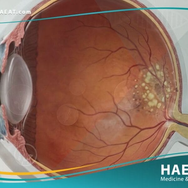 _التنكس البقعي