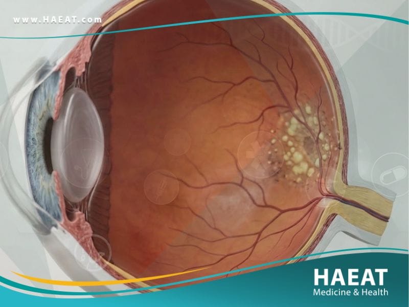 _التنكس البقعي