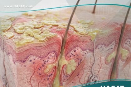 _التهاب الجلد المثي