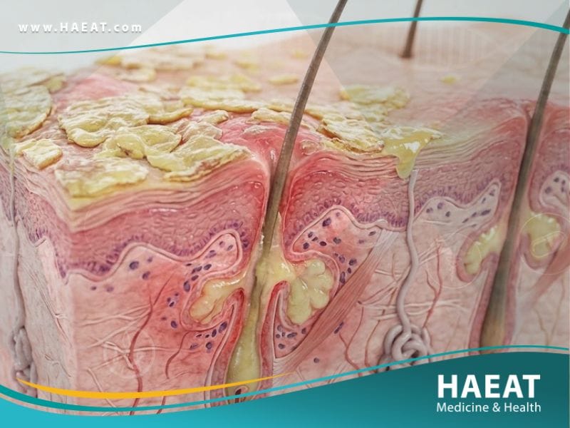 _التهاب الجلد المثي