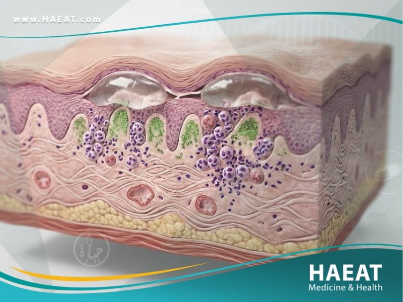 التهاب الجلد الهربسي الشكل | 7 أعراض، أسباب، وعلاجات 19 التهاب الجلد الهربسي الشكل