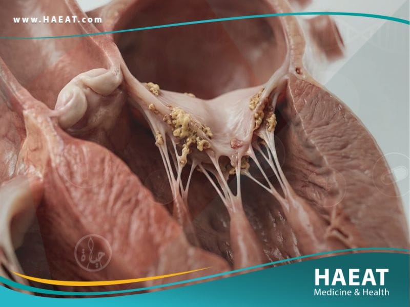 التهاب الشغاف العدوائي