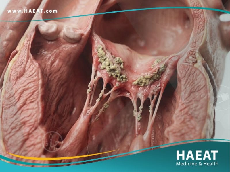 التهاب الشغاف