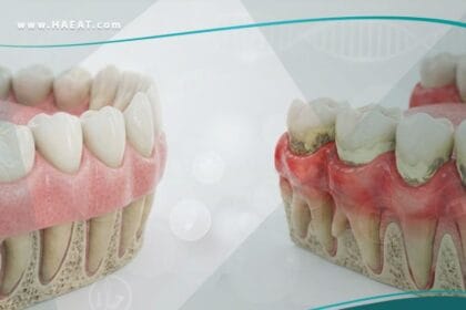 التهاب اللثة