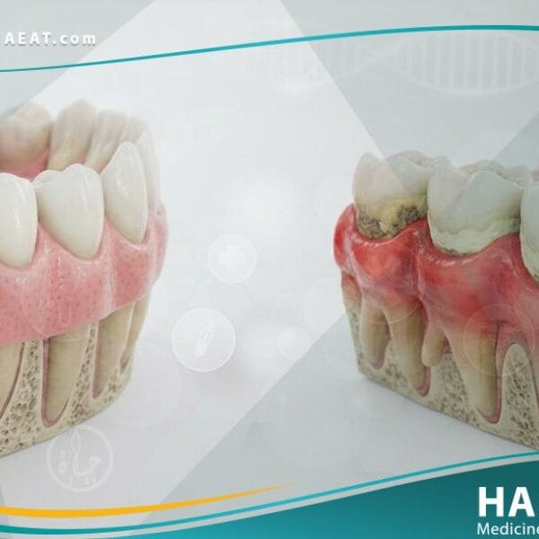 التهاب اللثة