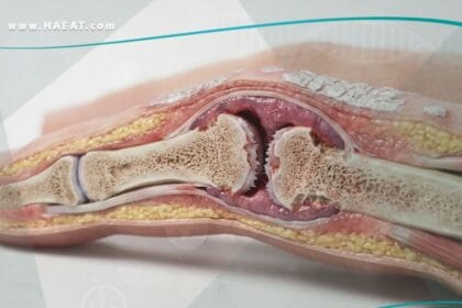 التهاب المفاصل الصدفي