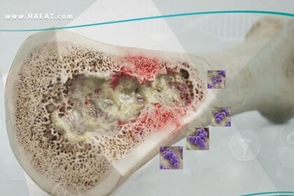 التهاب جهاز الهيكل العظمي