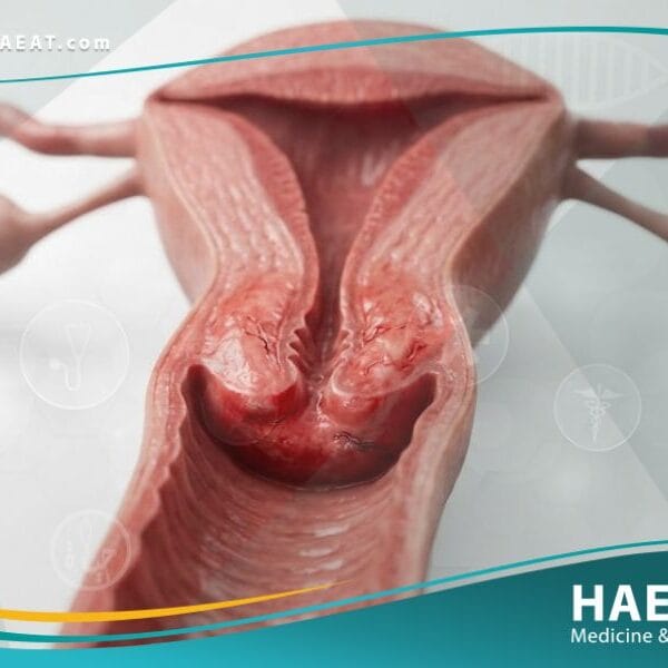 التهاب عنق الرحم (1)