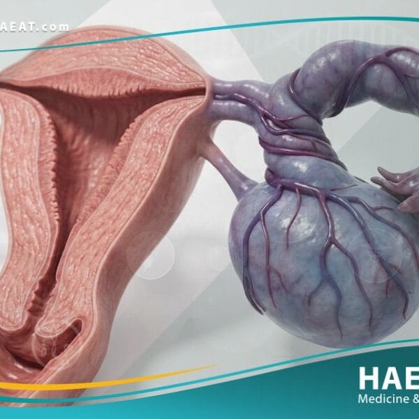 التواء المبيض