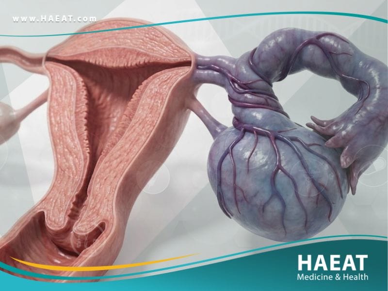 التواء المبيض