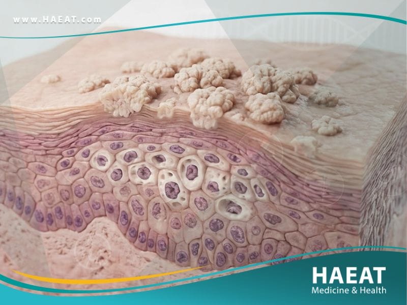 _الثآليل التناسلية