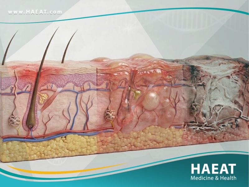 الحروق | 9 نصائح حول العلاج، الأعراض، وعوامل الخطر 19 الحروق