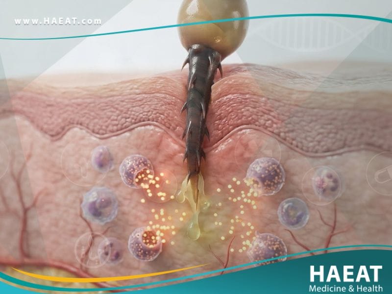 _الحساسية لسم الحشرات