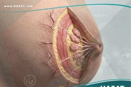 الحلمات المتصدعة