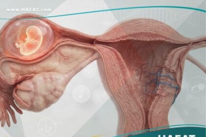 الحمل المنتبذ