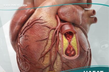 _الذبحة الصدرية