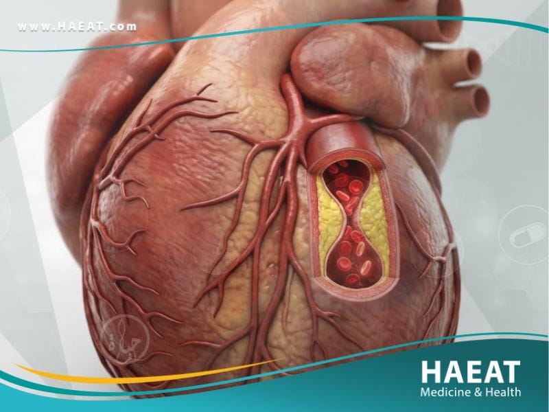 _الذبحة الصدرية