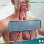 _الصدمة التأقية