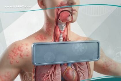 _الصدمة التأقية