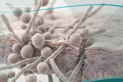 العدوى بداء المبيضات