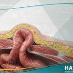 الفتق السري