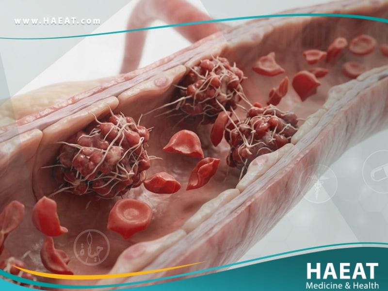 الفرفرية القليلة الصفيحات الخثارية