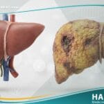 _الفشل الكبدي (1)