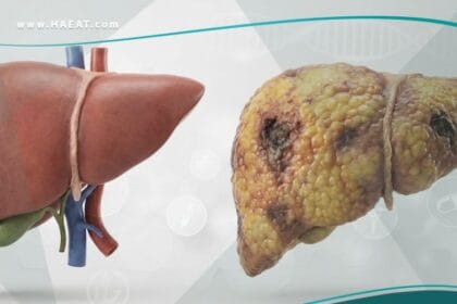 _الفشل الكبدي (1)