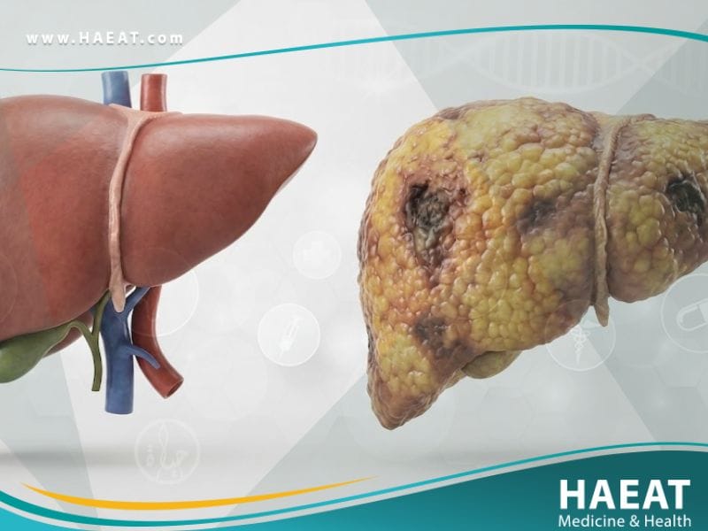 _الفشل الكبدي (1)