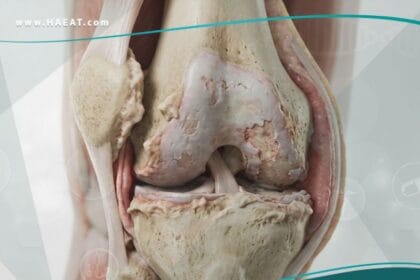 _الفصال العظمي