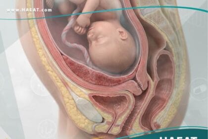 _المشيمة المنزاحة