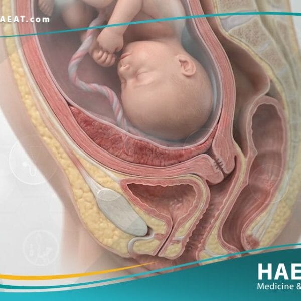 _المشيمة المنزاحة