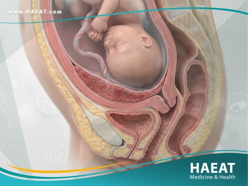 المشيمة المنزاحة | 7 حقائق عن الأعراض، الأسباب، والعلاج 19 _المشيمة المنزاحة
